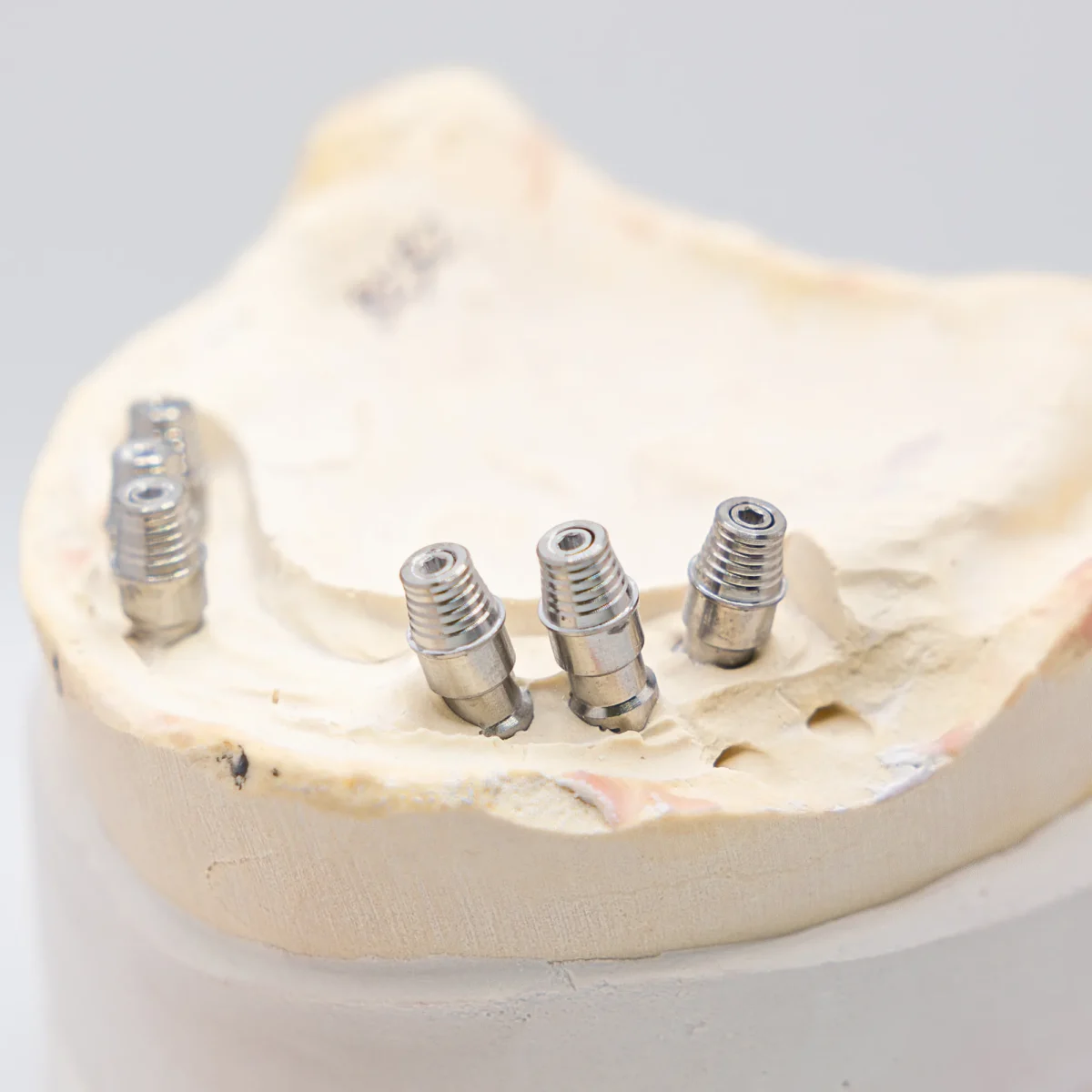 All-on-X multi-unit abutments seated on the master cast