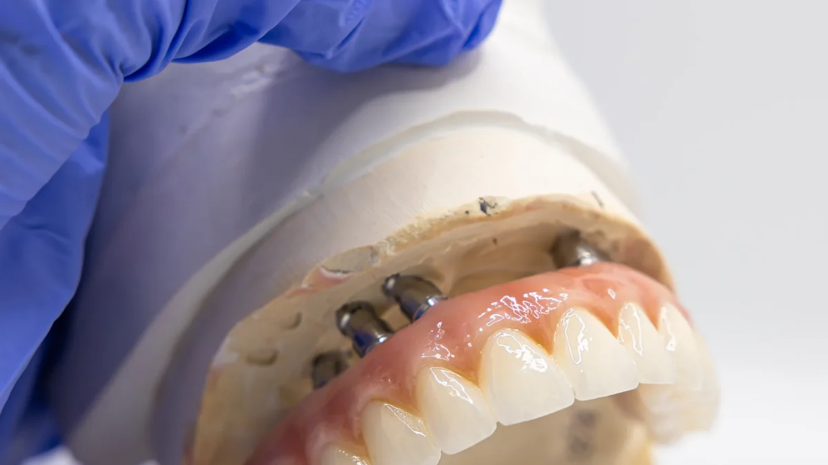 Occlusal screw channels positioned on a finished implant restoration at the lab bench