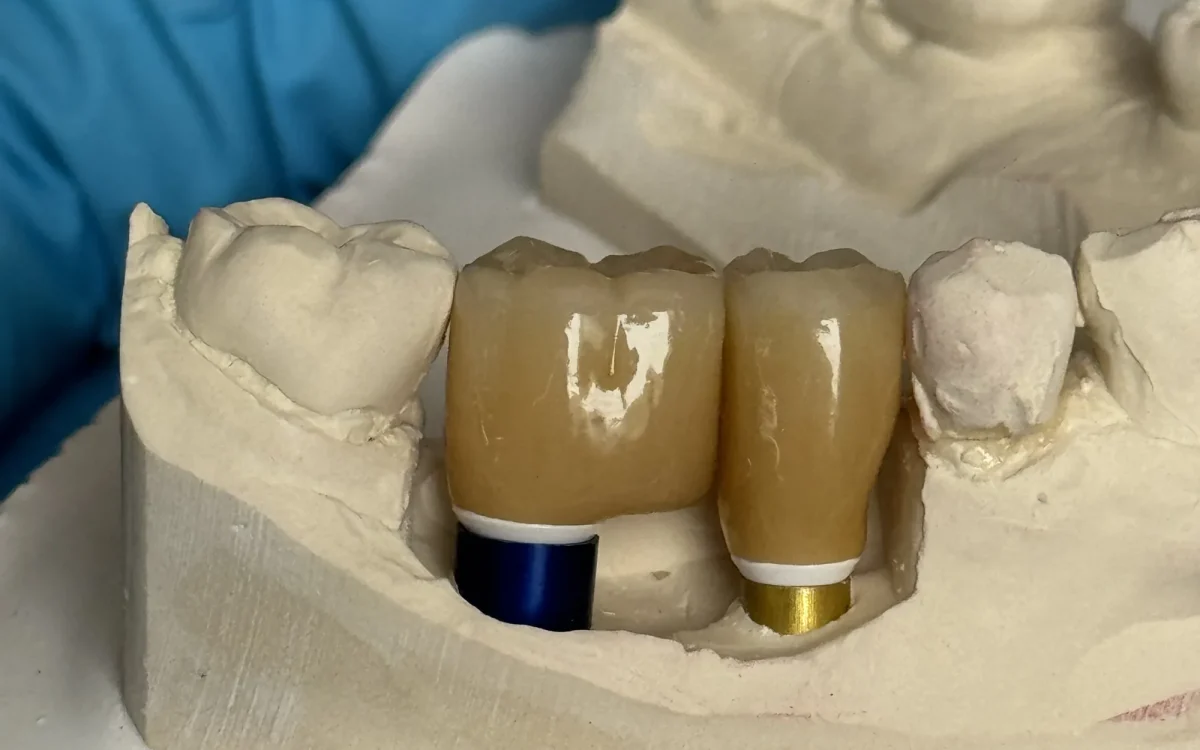 Two implant crowns seated on anodized custom titanium abutments on the master cast at the IDA bench