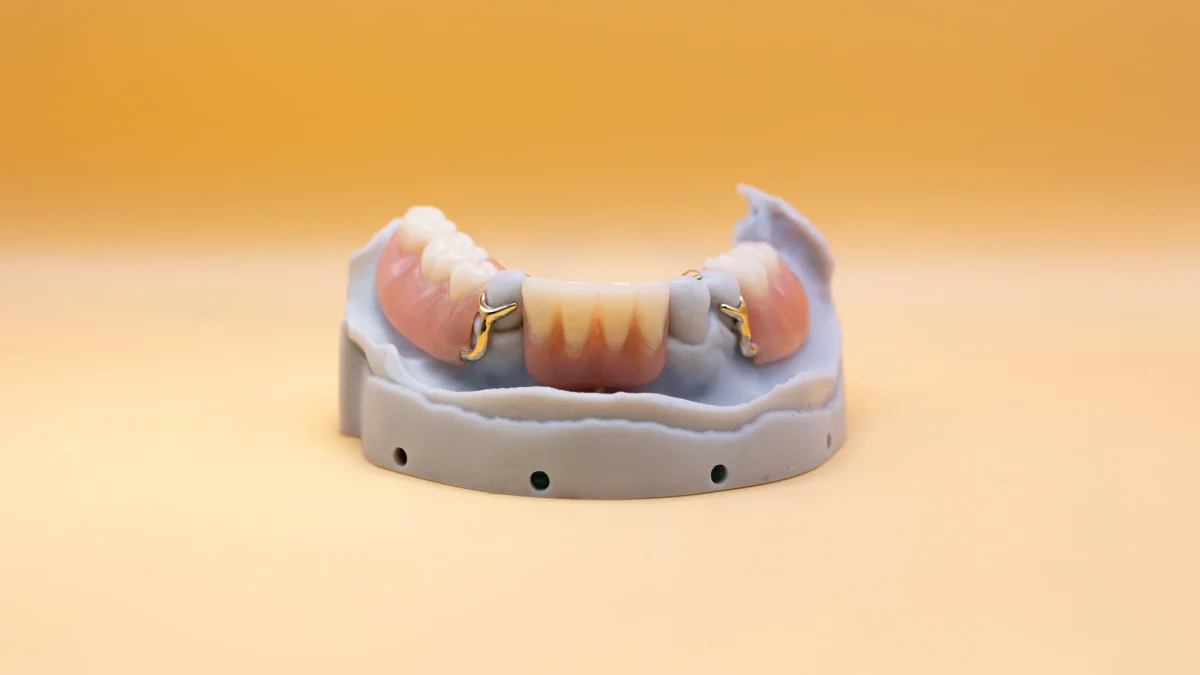 Mandibular cast partial denture on a model with gold clasp arms visible across the buccal surfaces