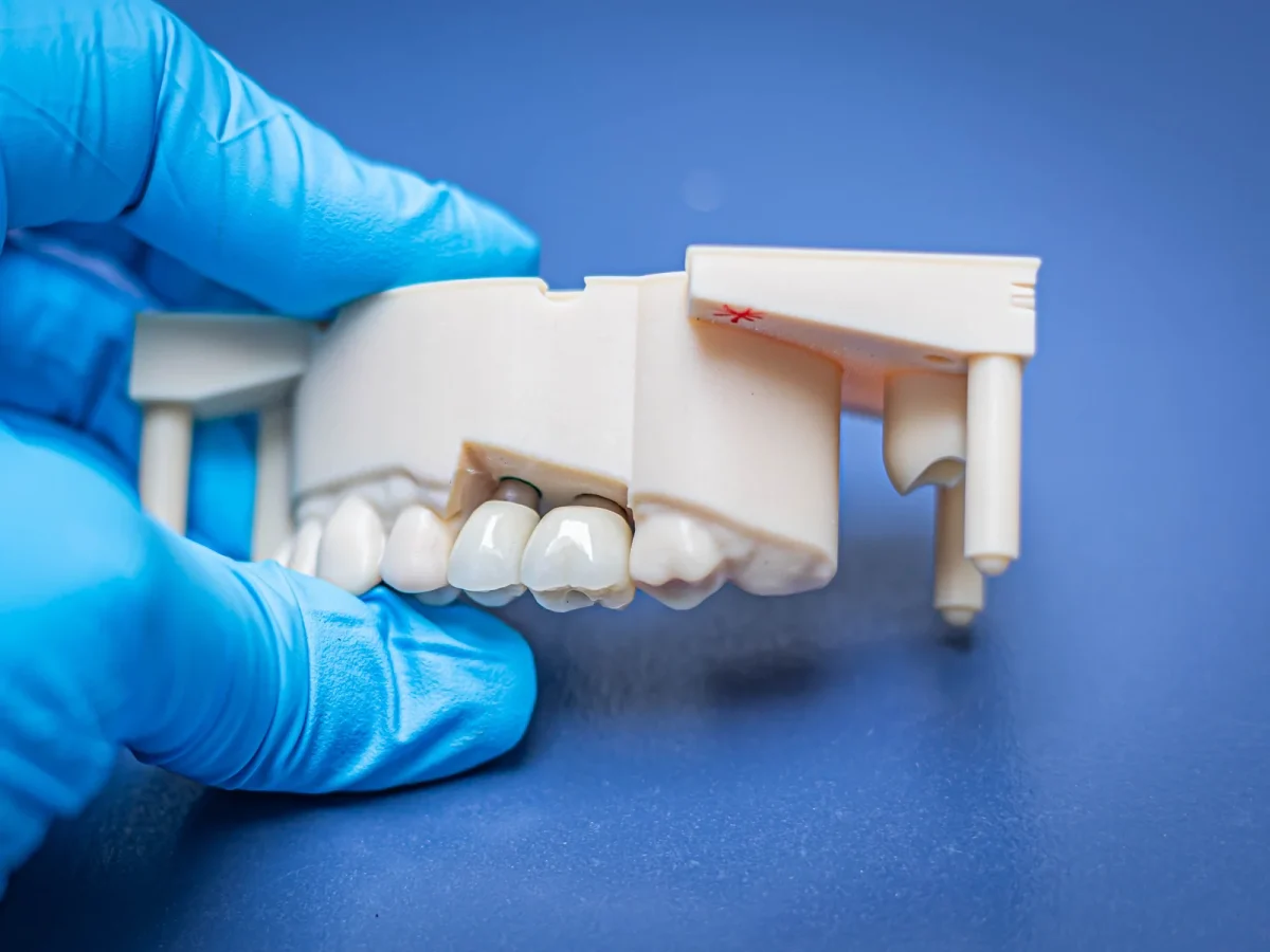 Implant crowns on a model held in a gloved hand