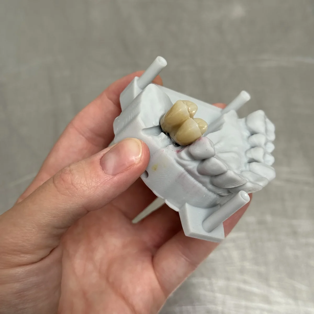 Screw-retained posterior implant crowns at the IDA bench