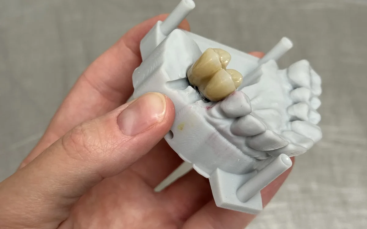 Screw-retained posterior implant crowns at the IDA bench