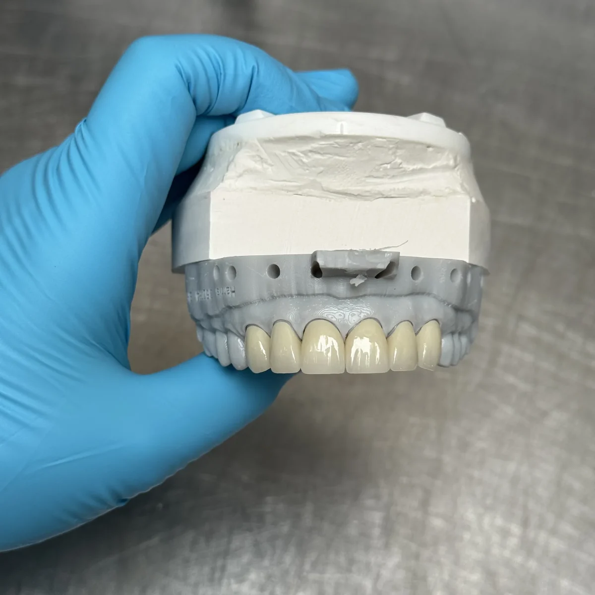 Anterior PFM crown with custom shade work