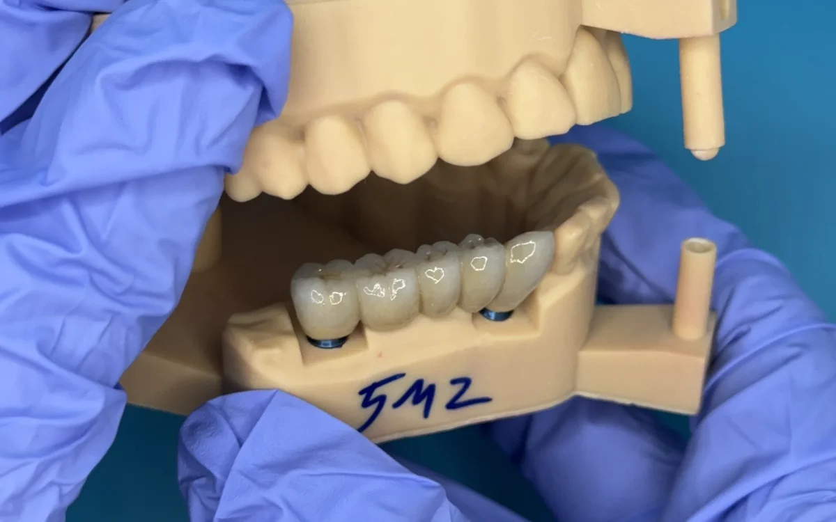 Screw-retained bridge, side view