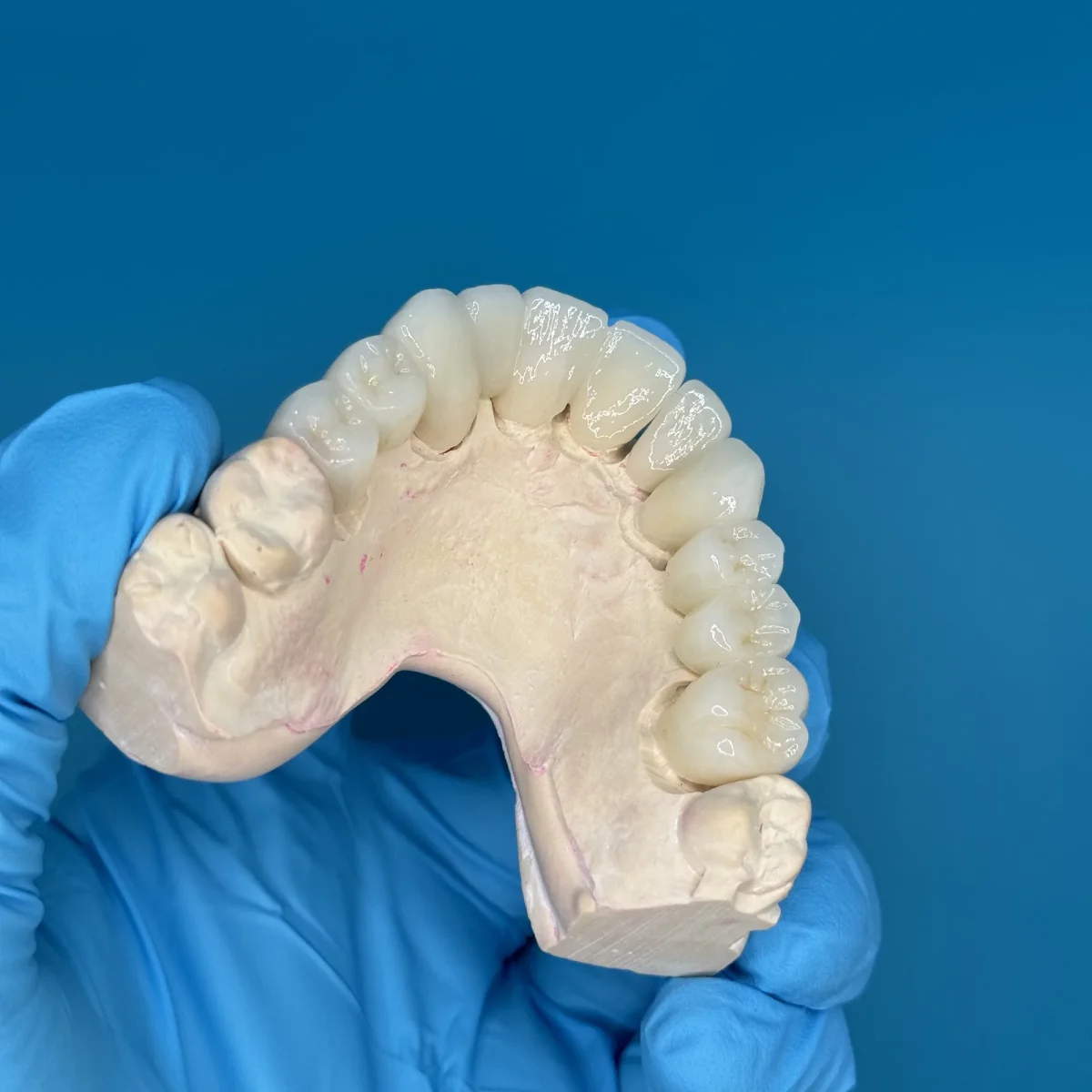 Zirconia bridge on a mandibular model at the IDA bench