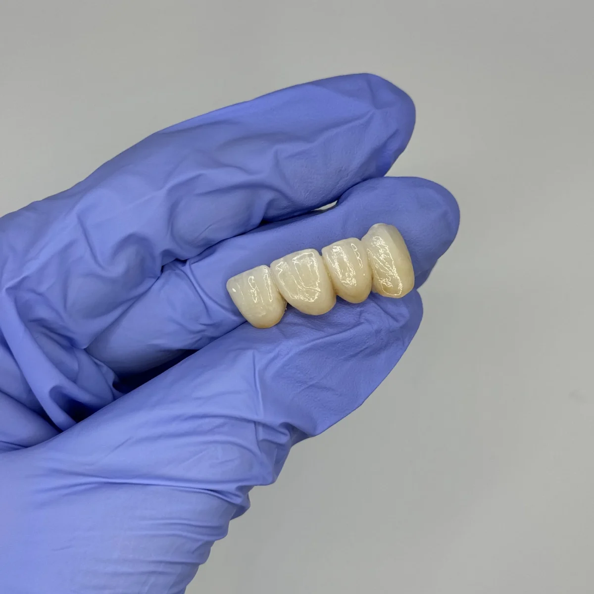 Full-arch monolithic zirconia restoration at the IDA bench