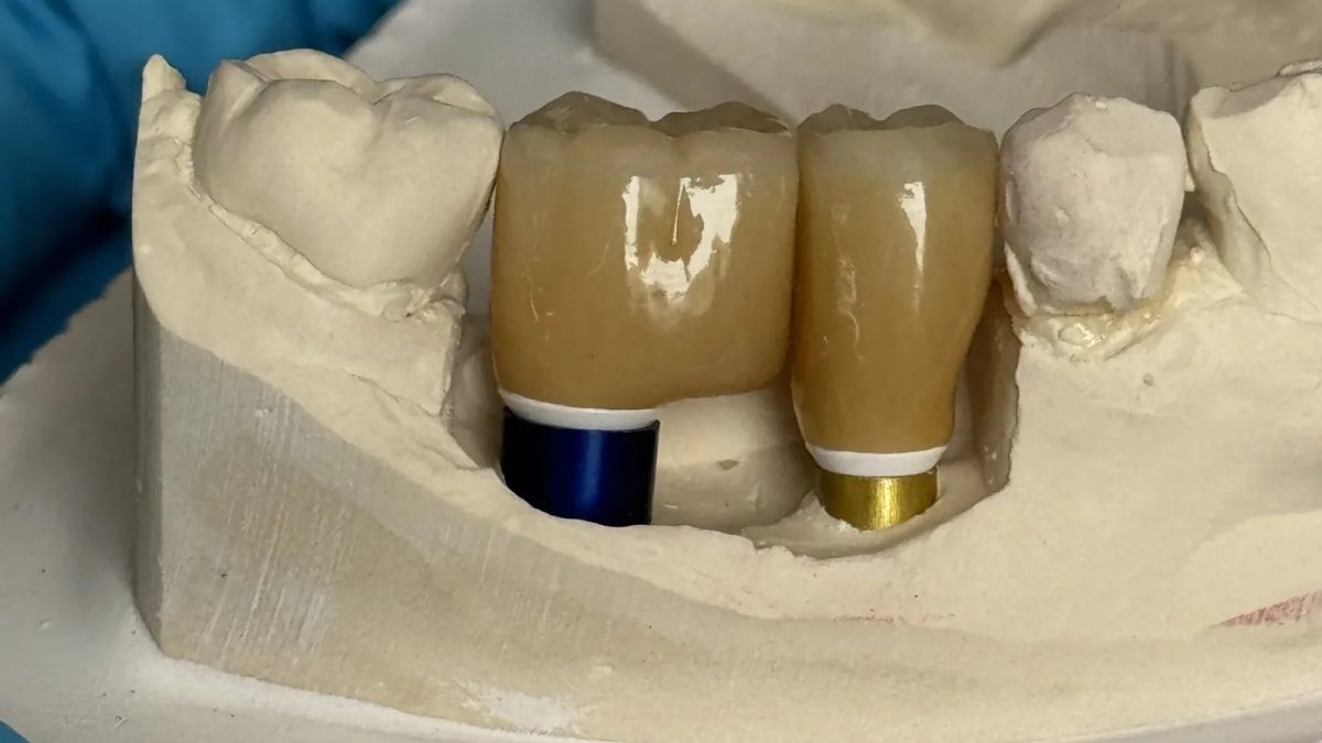 Two posterior implant crowns seated on anodised titanium abutments on a master cast at the IDA bench