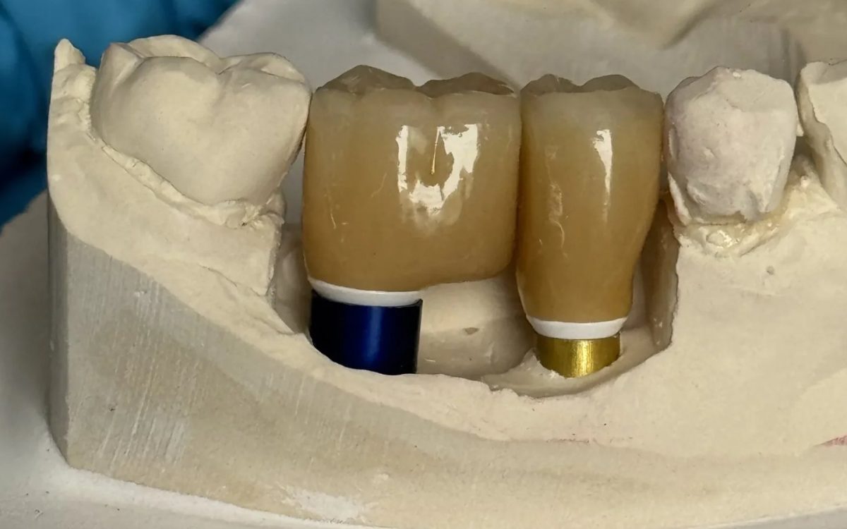Two posterior implant crowns seated on anodised titanium abutments on a master cast at the IDA bench