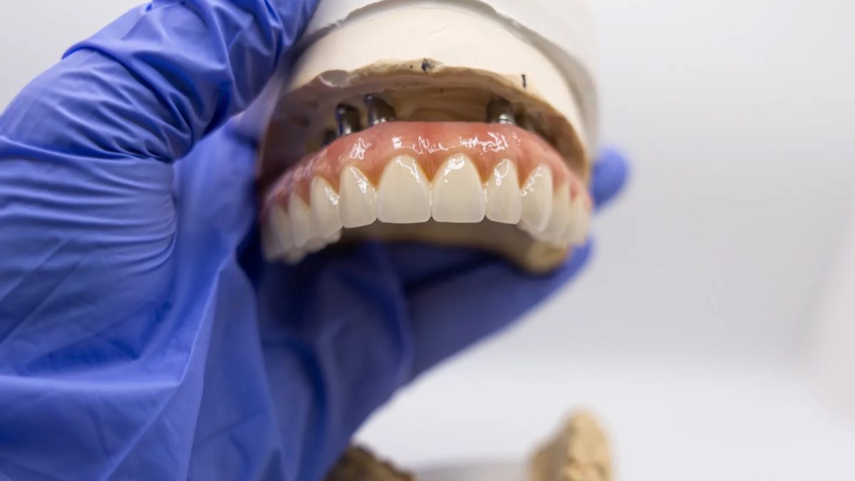 Maxillary All-on-X screw-retained full-arch prosthesis at the IDA bench