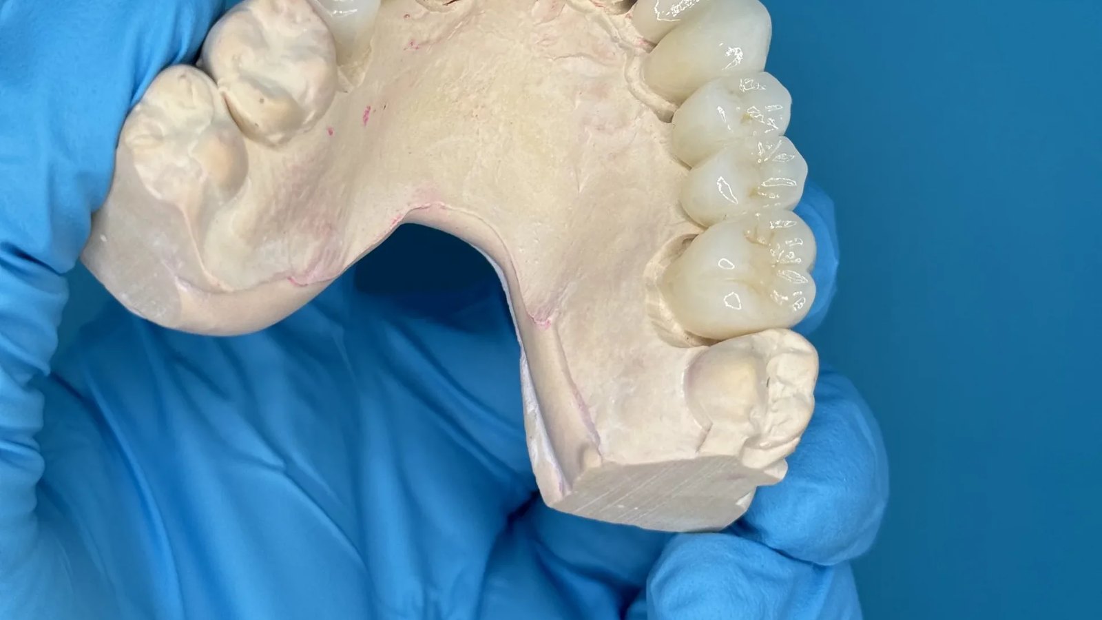 Zirconia restorations seated on a maxillary master cast at the IDA laboratory