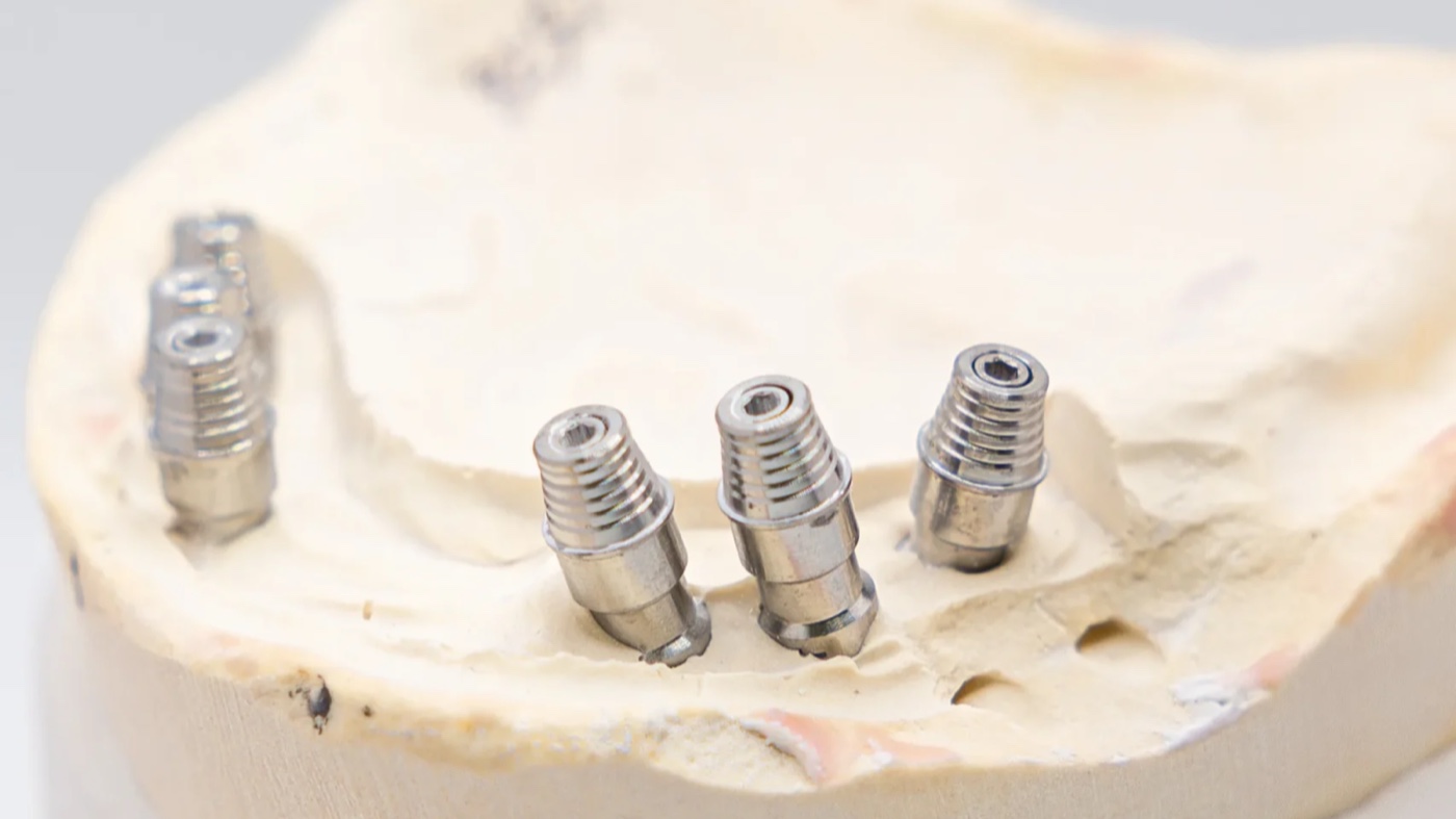 Multi unit abutment components seated on a master cast at the IDA laboratory before framework fabrication